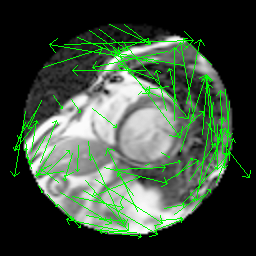 MRI Optical Flow GIF