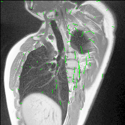 MRI Optical Flow GIF